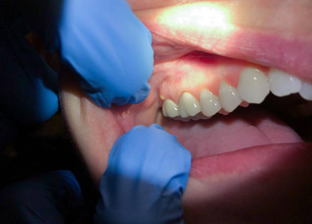 Best Broken or Cracked Tooth Emergency Dentist in Rich Hill, MO